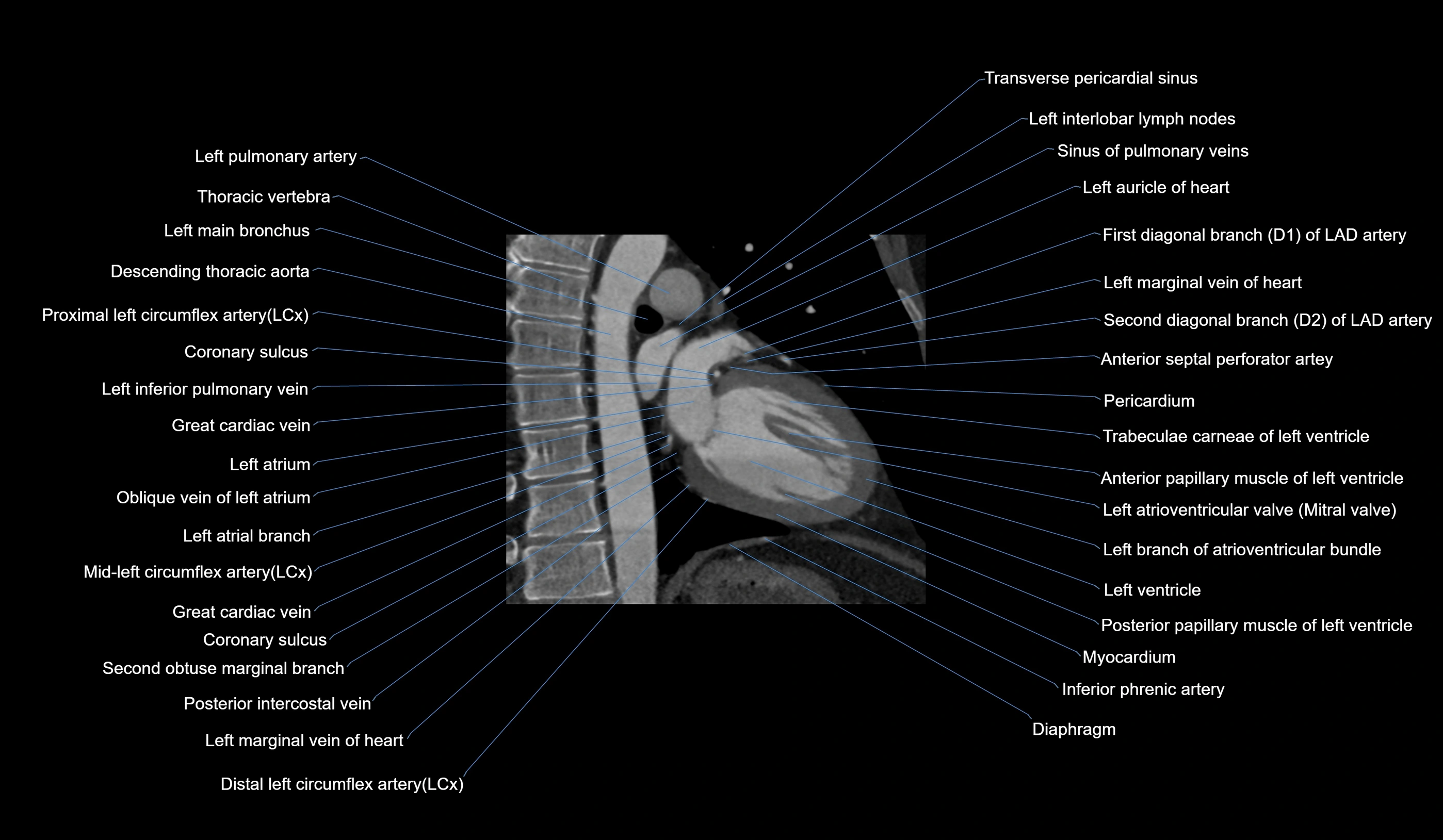 CT heart (coronary angiogram) 2 chamber view cross sectional anatomy labelled radiology image-00010.webp